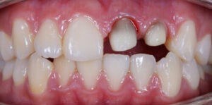 Prepared upper front teeth before placement of dental crowns.