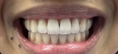 Straighter smile after clear-aligner treatment.