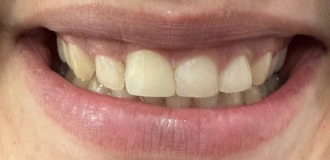 After treatment showing the restored upper front tooth.