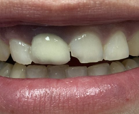 Before treatment showing a chipped upper front tooth.
