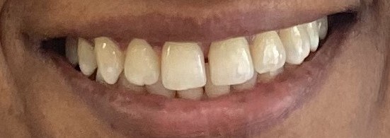 Smile before professional teeth-whitening treatment.